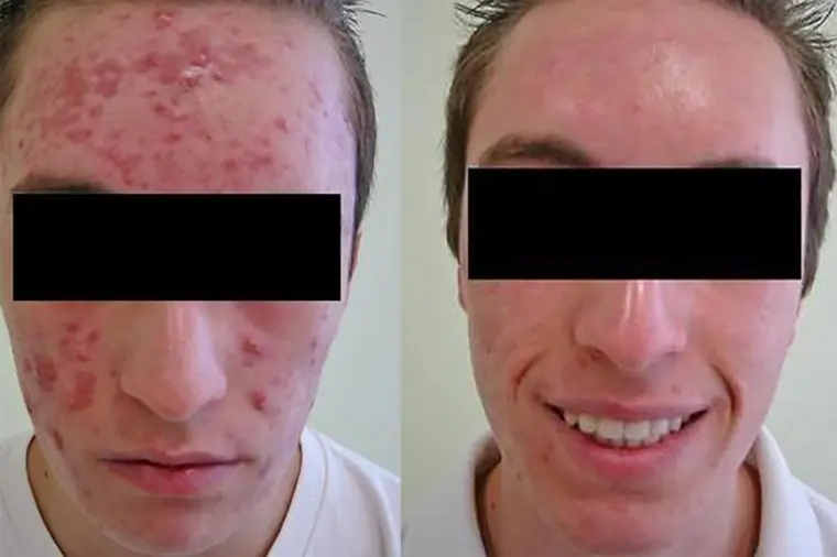 

FREE SHIPPING NEW RETINOL 0.025% Retin VITAMIN A Face CREAM Acne Anti wrinkles Blemish treatment 10g