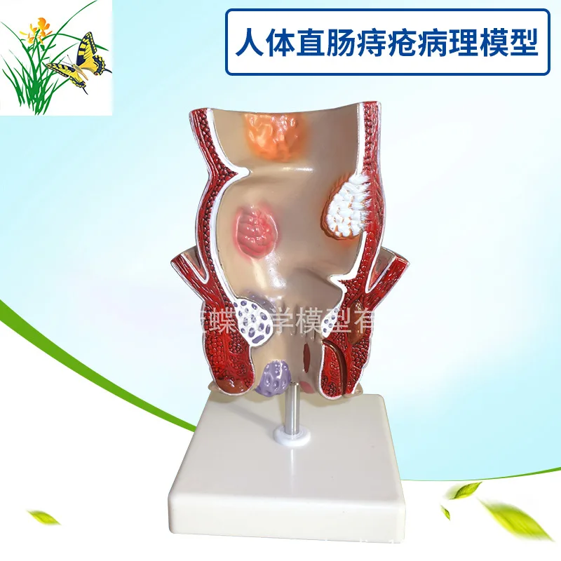 5-кратная анатомия человека модель поражения ректального геморроя внутренняя