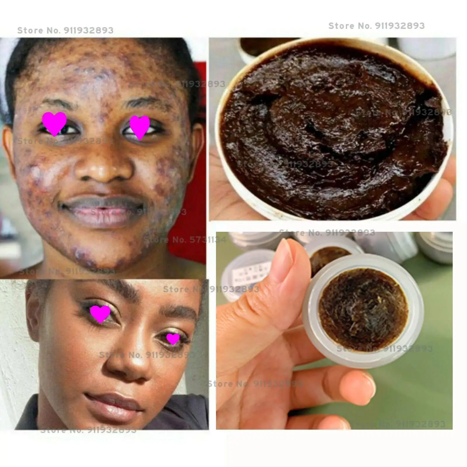 Tumeric Kojic Black soap, Herbal black soap,Acne, Dark Spots Remover, Clear Skin 10g