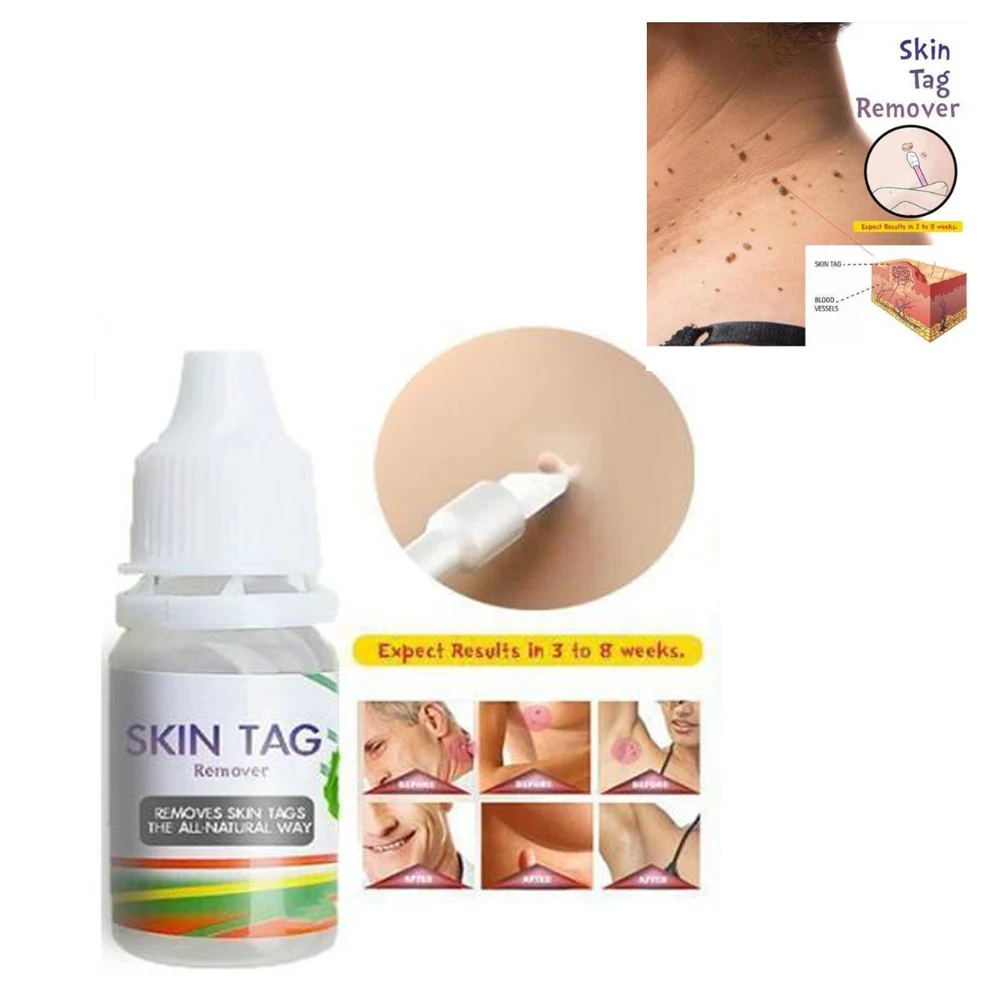 Крем для лечения бородавок и кожи удаления кожных ярлыков ног кукурузы