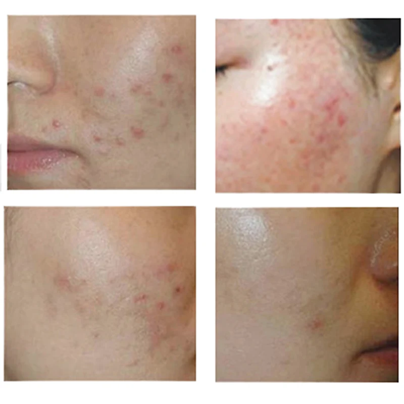 Bioaqua 30g Anti Acne Cream Oil Control Shrink Pore Acnes Scar Remove Face Care Treatment Blackhead Remova Whitening | Красота и