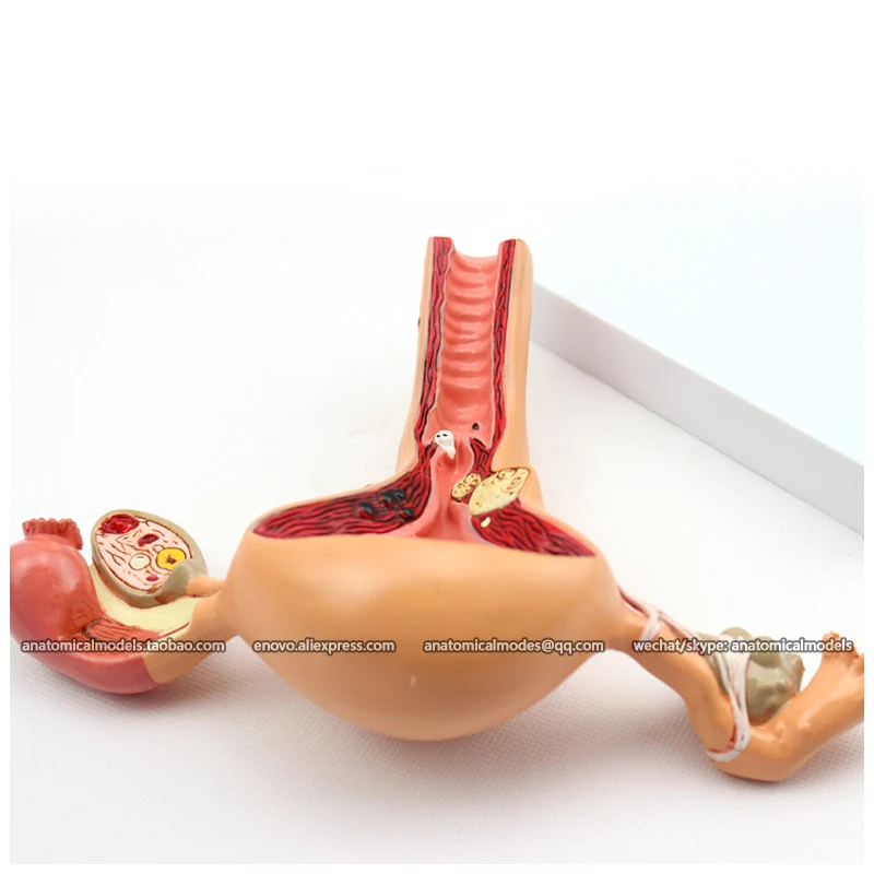 12441/патологические женской матке и яичницы медицинская анатомическая модель