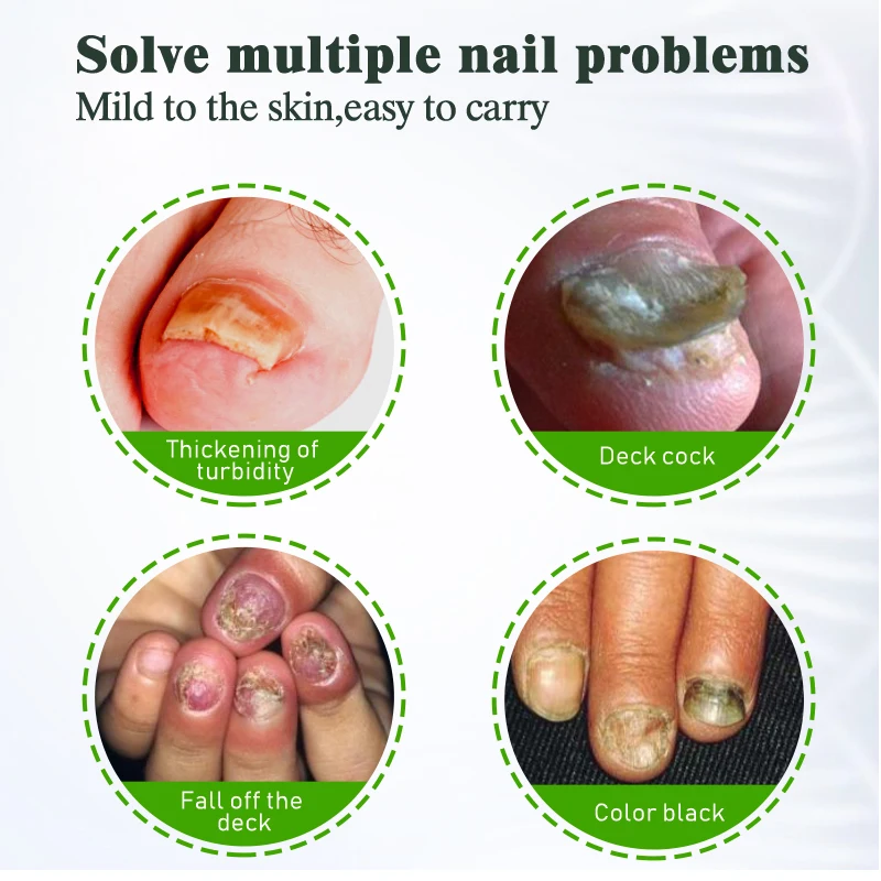 1 шт. Крем для лечения грибка ногтей Удаление паронихии онихомикоза мазь