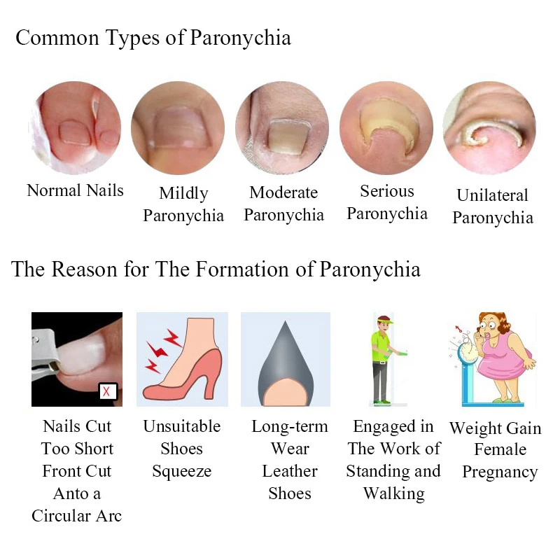 

12 Pcs/bottle of Ingrown Toenail Indent Correction Tool Nail Toe Pedicure Elastic Patch MPwell