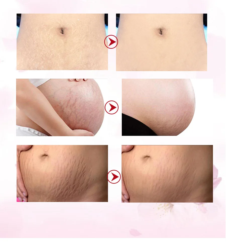 Remove Pregnancy Acne Scar Stretch Mark Cream Treatment Maternal Anti-aging Repair Anti-wrinkle Firming Body | Красота и здоровье