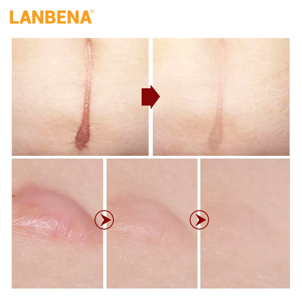 LANBENA 40g удаление рубцов растяжек травяной крем шрама для ухода за кожей и продукты