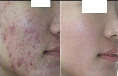 

Acne cream to acne marks to close mouth acne faded Peas artifact back acne men and women repair cream 30g