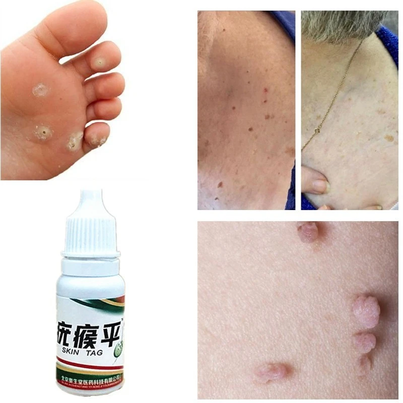 

10ml Skin Tag Remover Skin Tags Genital Wart Remover Foot Care Cream Treatment Foot Corn Removal Blackhead Remover Liquid