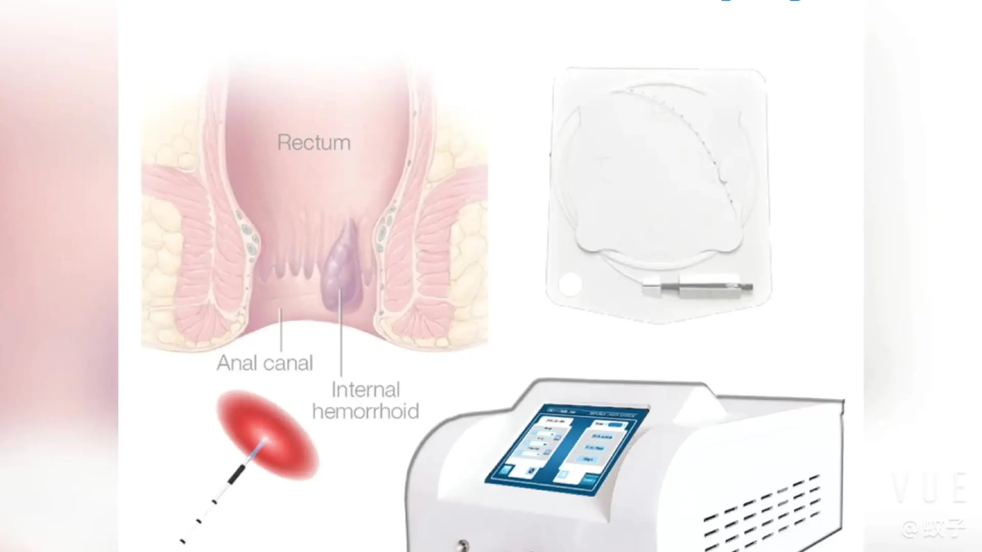 

Arfurla 1470nm diode laser anoscope for haemorrhoid lasere treatment hemorrhoid laser surgery