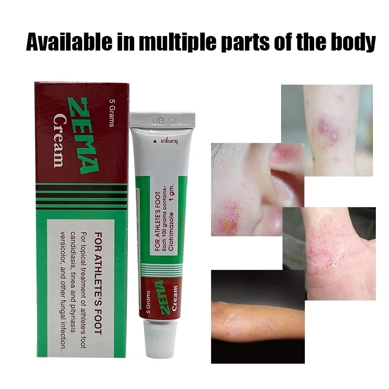 

ZEMA Skin Antibacterial Cream Natural Ointment Psoriasis Eczma Cream Work Really Well For Dermatitis Psoriasis Eczema Urticaria
