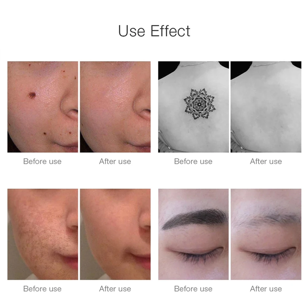 

Electric Plasma Pen Neatcell Handheld Picosecond Laser Tattoo Removal Profesional Machine Scar Moles and Freckle Removal Device