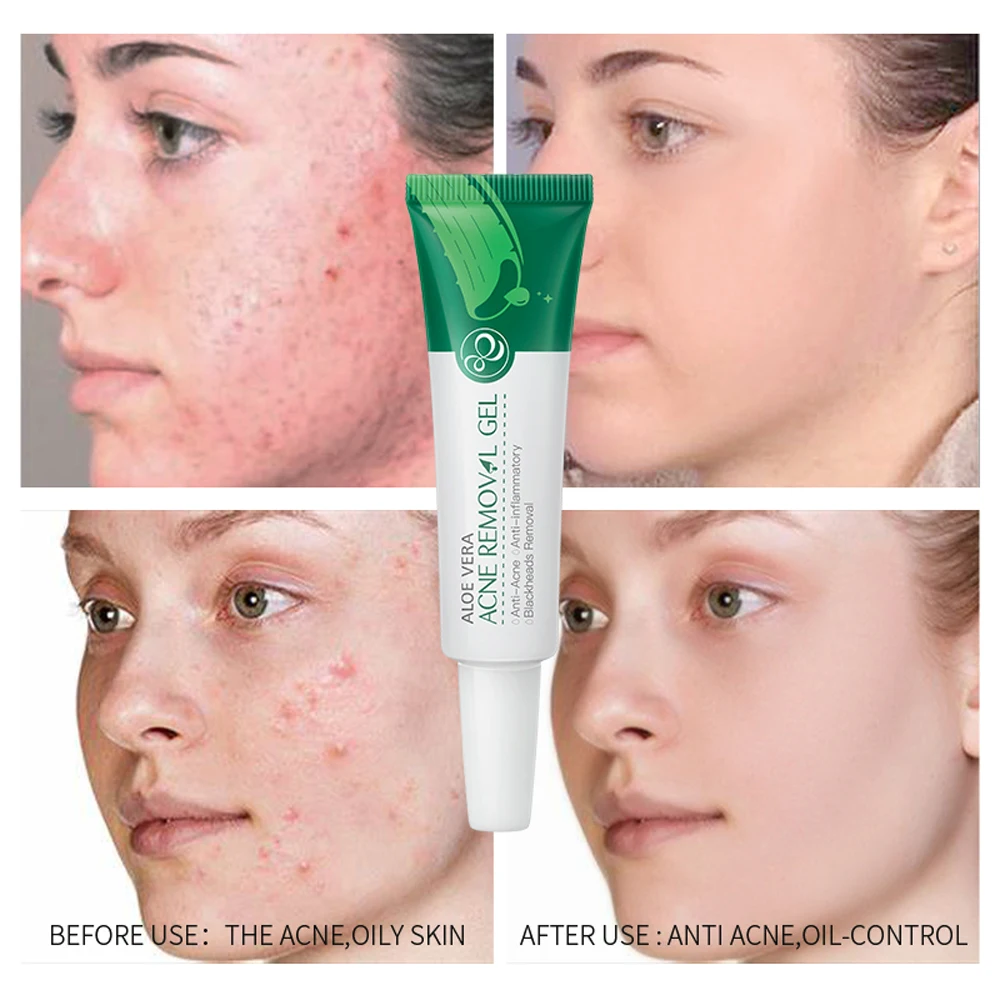 

Effective Aloe Acne Removal Cream Acne Treatment Gel Fade Acne Spots Oil Control Shrink Pores Moisturizing Acne Scar Skin Care
