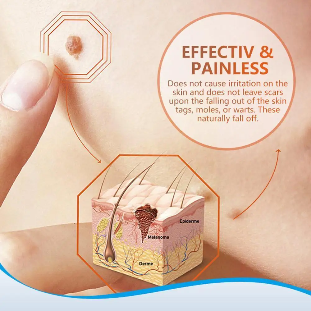 Крем для бородавок антибактериальный крем удаления микро мазь уход за мужями