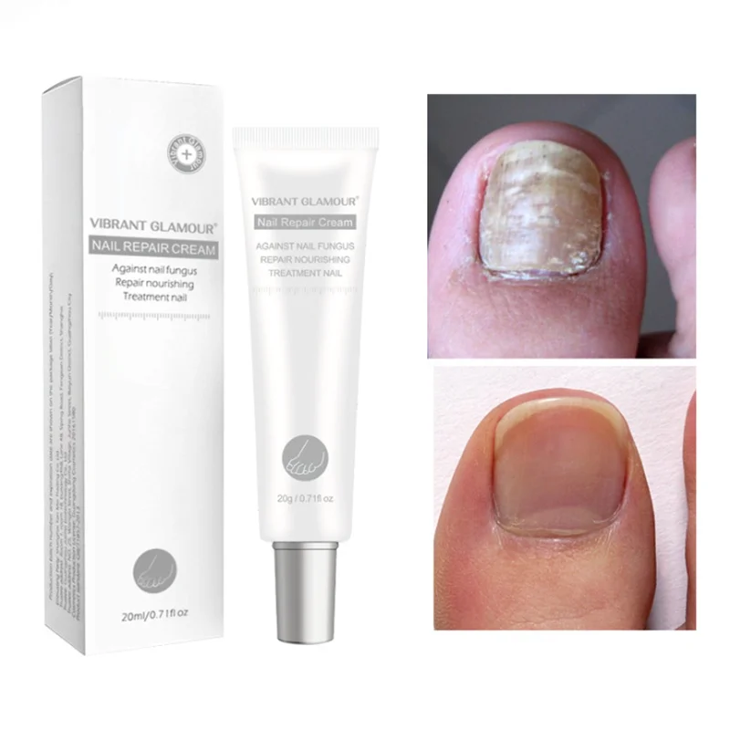 

20g Toenail Care Repair Cream Anti Fungus Nail Toe Antifungal Onychomycosis Repairing Promote Nail Growth Brighten Nail