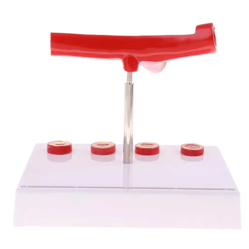 Лабораторные принадлежности 50 раз увеличенный человеческий сосуд атеросклероза