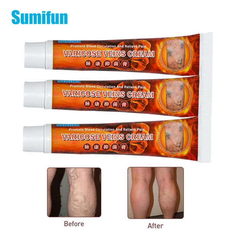 

3pcs Varicose Veins Miracle Cream Varicosity Angiitis Remedy Ointment Relief Veins Pain Phlebitis Spider legs Health Care D3175