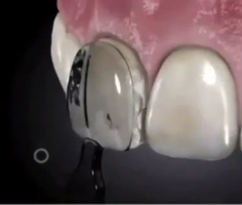 30 шт./кор. зубная форма из композитной смолы светильник строй отверждения