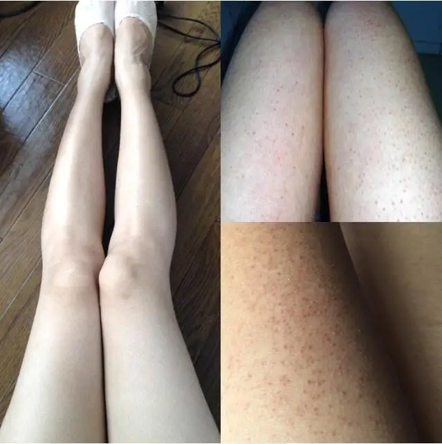 Отверждающий кератоз Pilaris/ Kp/лосьон для кожи курицы и тела крем восстановления