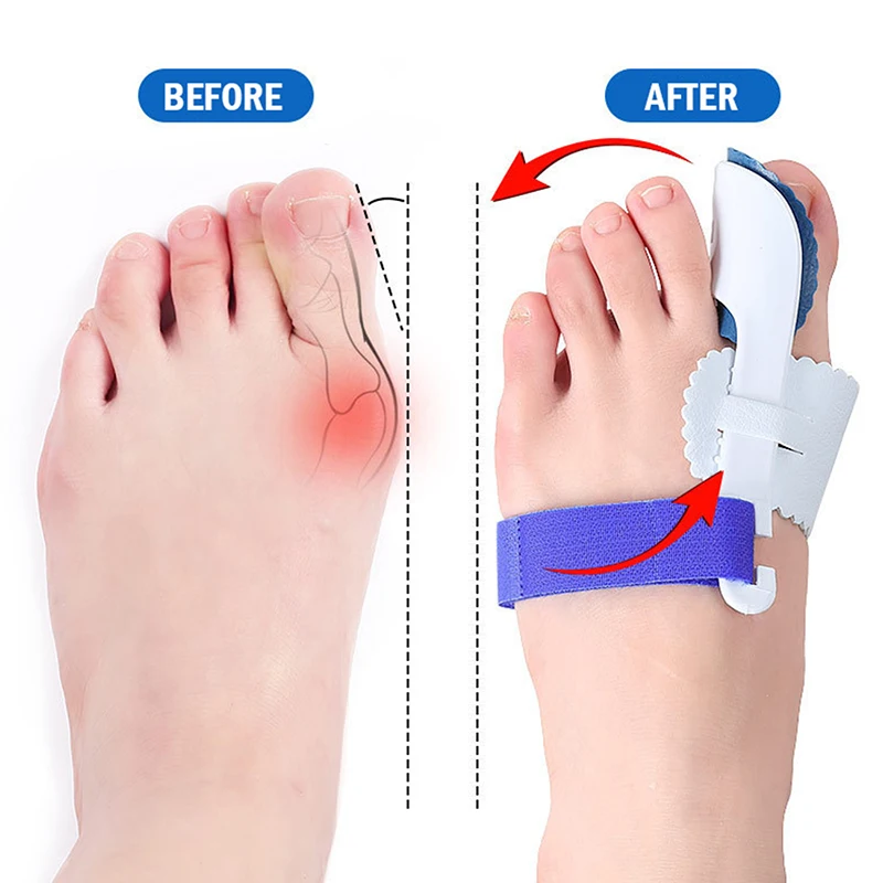 

2 шт., разделитель для большого пальца ноги при вальгусной деформации