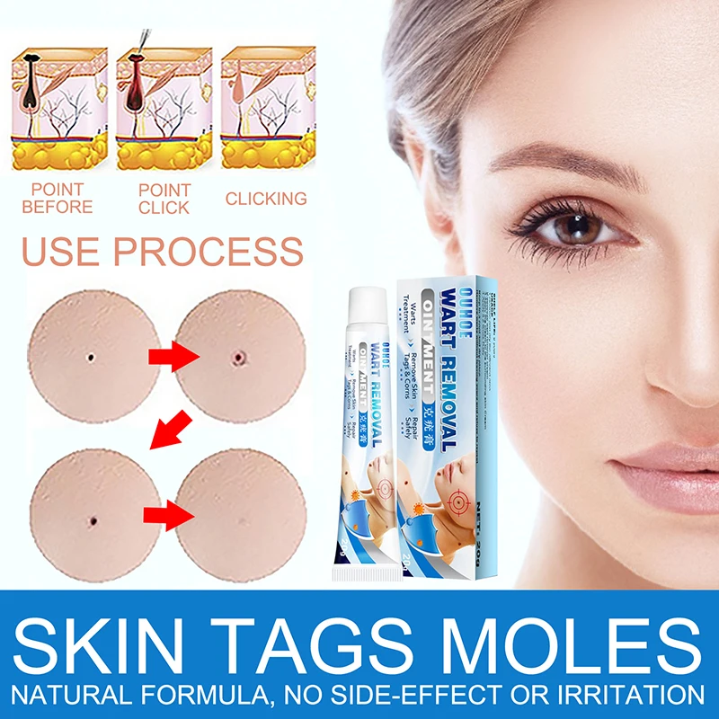

Warts Remover Cream Gram Wart Ointment Skin Tag Remover Extract Corn Plaster Warts Ointment Effective And Scar-Free Antibacteria