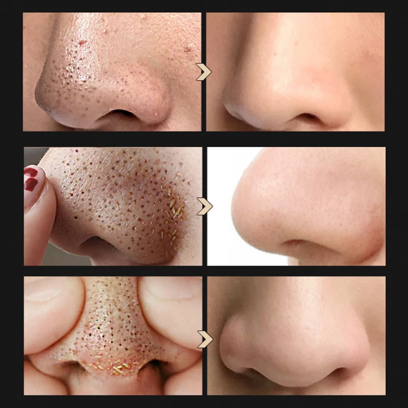 

BREYLEE Face Blackhead Serum Blackhead Remover Shrinking Pore Acne Treatment Deep Cleaning Smoothing Skin Care with 100 paper