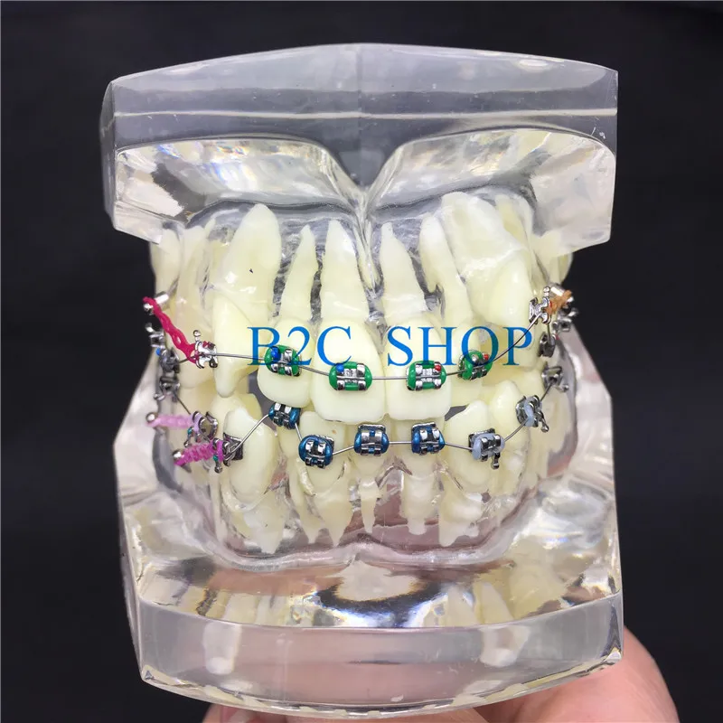 Стоматологическая Ортодонтическая модель с красочными кронштейнами для