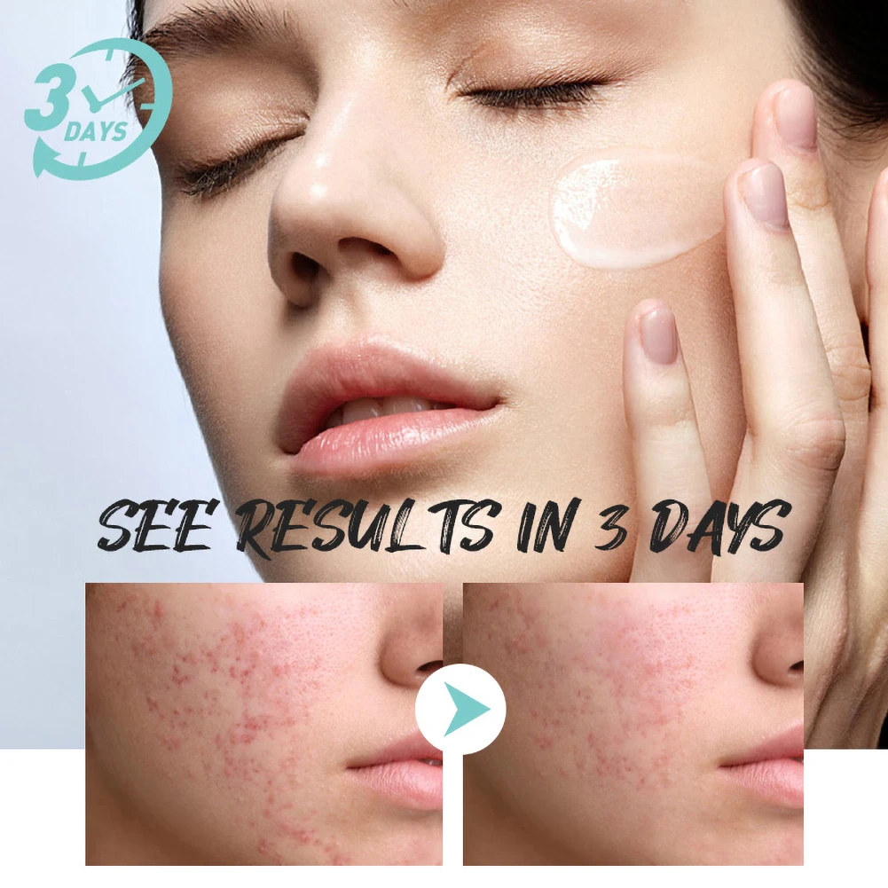 

Relief Eczema Cream Psoriasis Cream Herbal Dermatitis Skin Rash Urticaria DesquaMation Skin Treatment Cream 20g