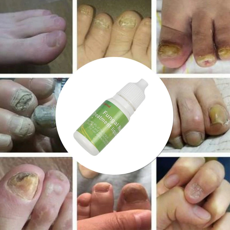 

Chinese Medicine Herbs Toe Nail Fungus Treatment Anti Fungal Nail Infection Nail