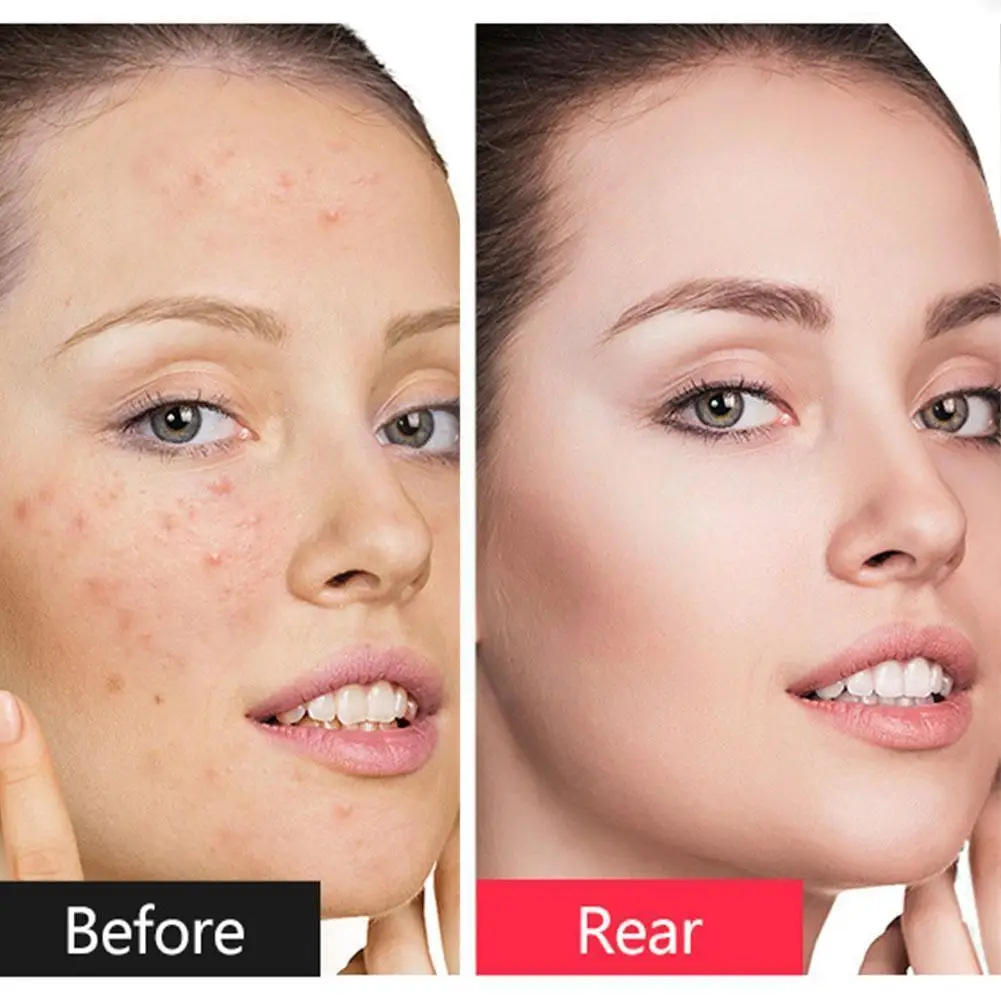 

140g Bath And Cleansing Soap Handmade Body Cleaning And Brighten Acne Care Moisturizing Skin Whitening Anti Product Skin G5K6