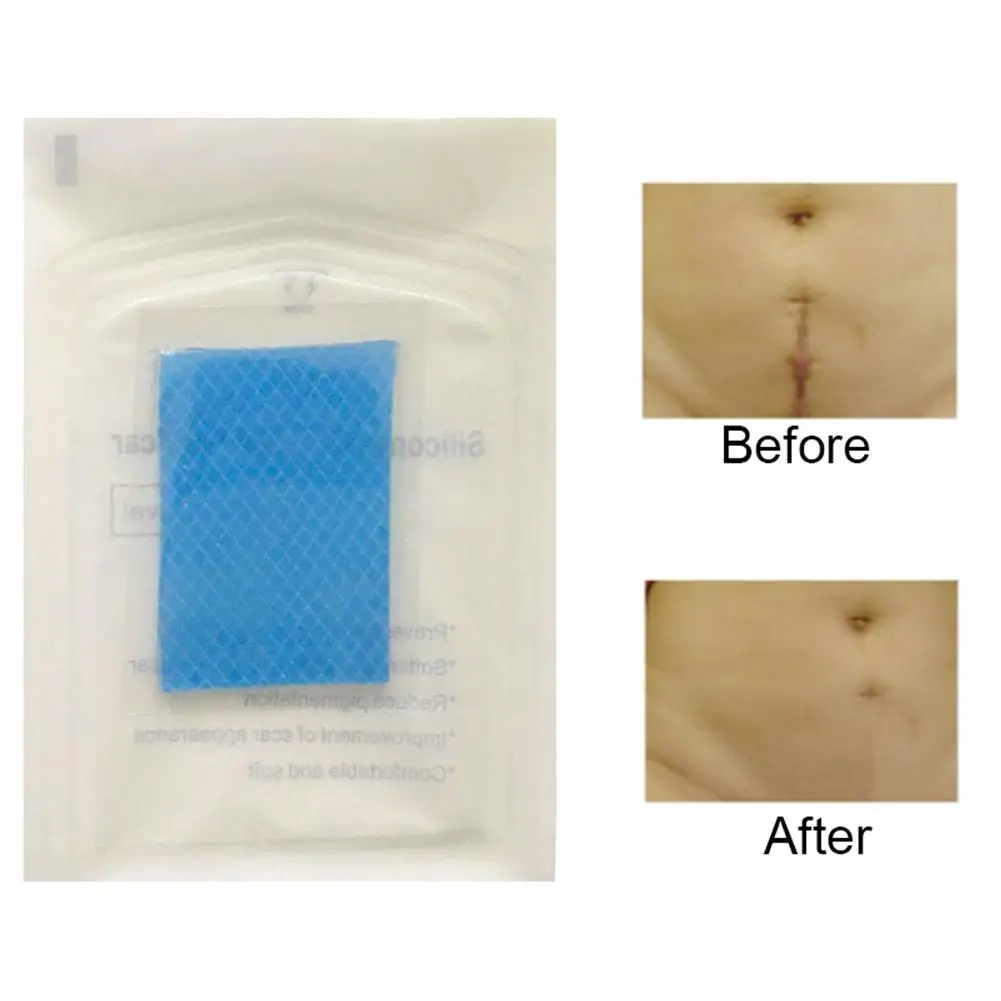 Новый силиконовый лист для удаления шрамов от цезареза лечение акне травм