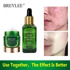 Крем для лица BREYLEE для лечения акне, набор для удаления следов акне, сужения пор и контроля жирности лица, эссенция для гладкого отбеливания, уход за кожей лица