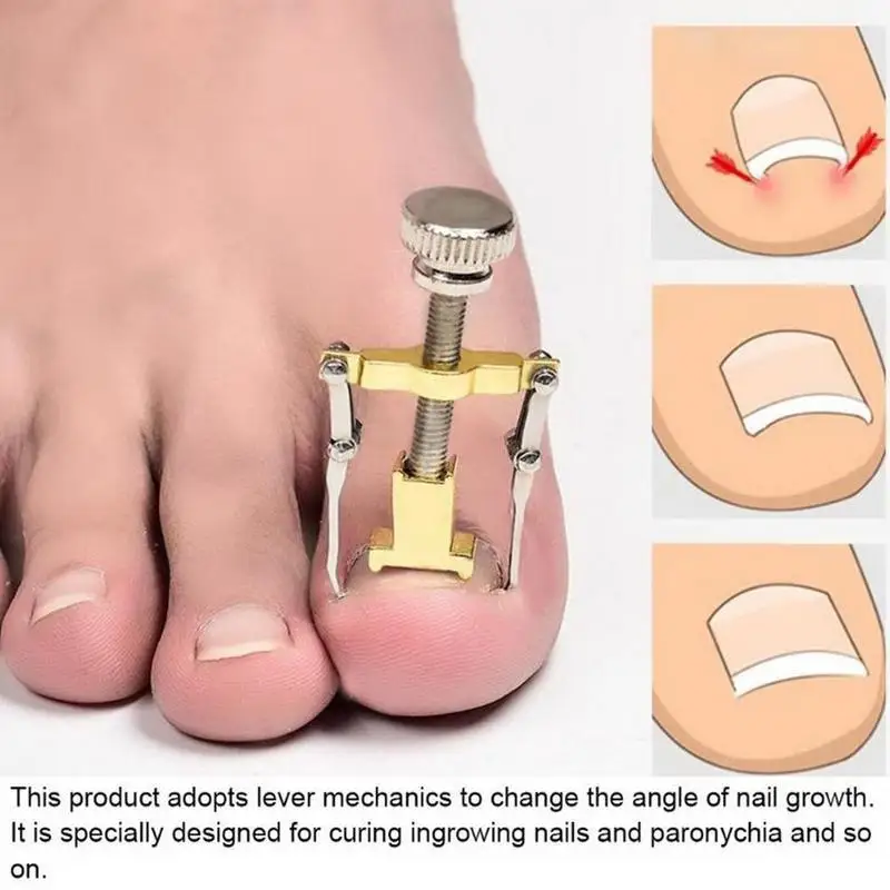 Новые металлические ортопедические принадлежности средство для восстановления
