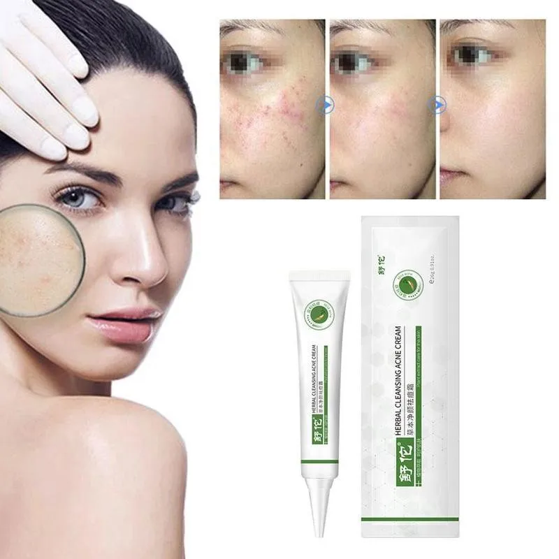 

Acne Cream Herbal Cleansing Repairing Acne Pits Acne Cream Skin Hrink Care Acne Marks Treatment Pores Whitening Face Acne E0Y2