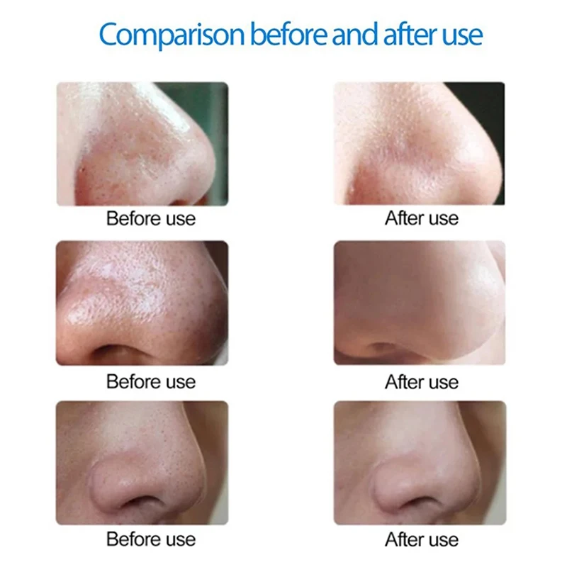 

Hot Mini Portable Blackhead Pore Remover Tool Face Cleanser Beauty Instrument Vacuum Extractor Acne Suction Skin Care EY669