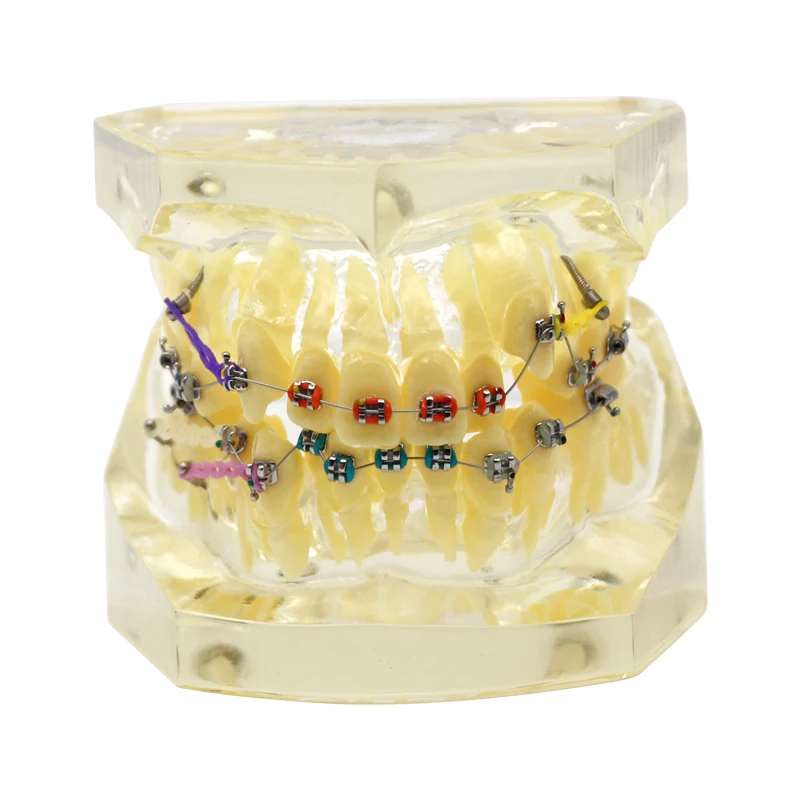 

1 шт., прозрачная Стоматологическая Ортодонтическая модель с керамическими цветными металлическими скобами для общения пациентом