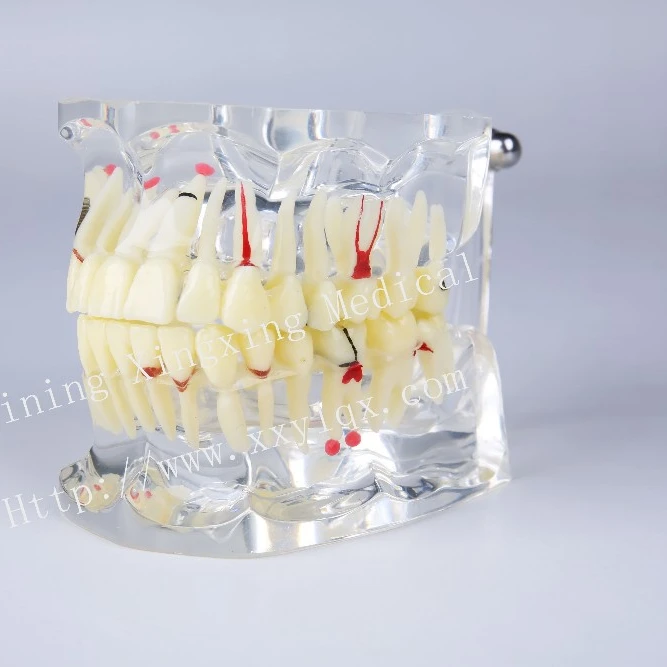 

typodont for adult pathologies tooth Model