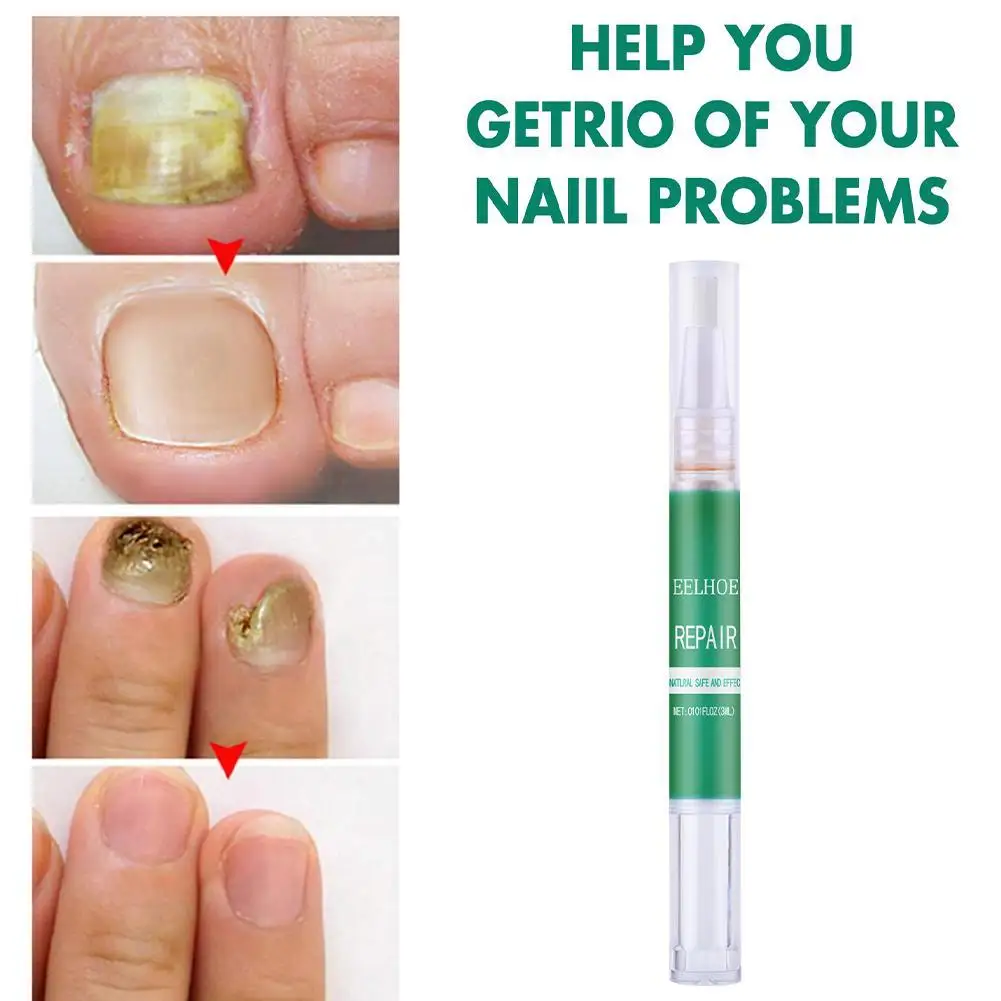 

Ручка для ухода за ногтями Набор для лечения против грибков ручка для лечения Ногтей онихомикоз паронихия набор для ухода за грибком