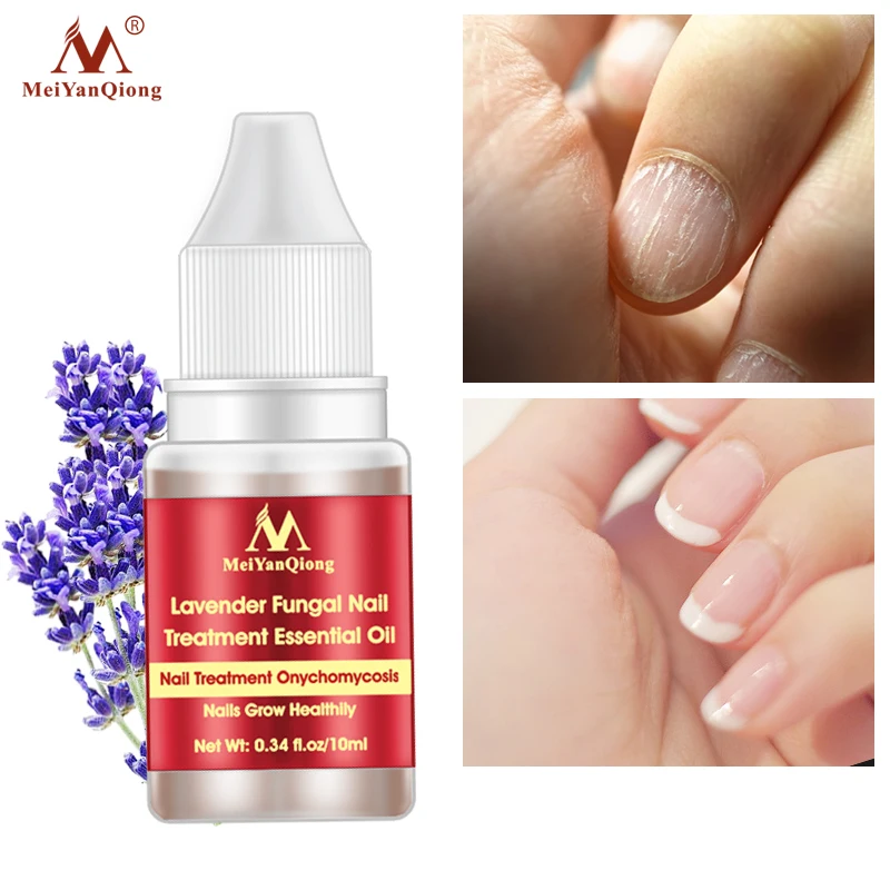 

Lavender Fungal Nail Treatment Essential Oil Onychomycosis Paronychia Anti-Fungal Herbal Toe Fungus Foot Repair Essence Care