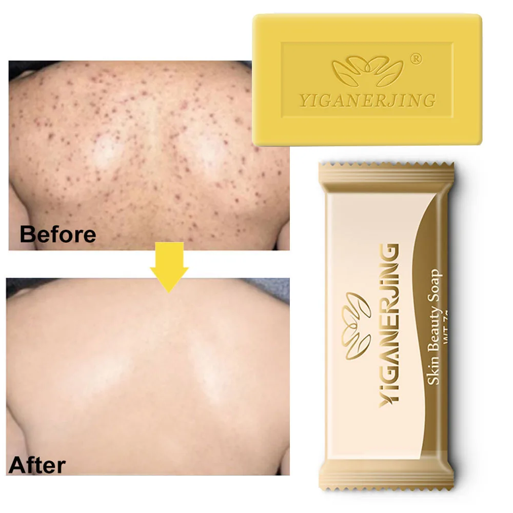 

5Pcs YIGANERJING Sulfur Soap Trial Pack Skin Antibacterial Treatment Acne Psoriasi Seborrhea Eczema Anti Fungus Bath Beauty Soap