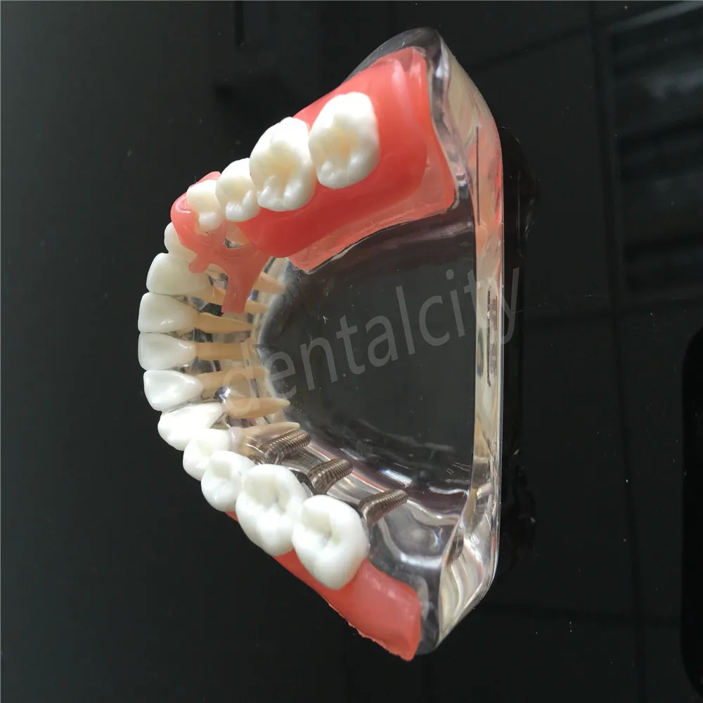 Модель имплантата для зубных протезов с сосудов демонстрация 6006 | Красота и