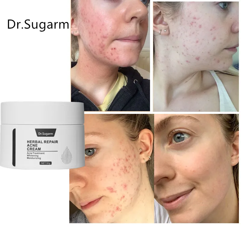 

Acne Treatment Face Cream Blackhead Repair Gel Oil Control Shrink Pores Scar Whitening Moisturizer Skin Care Korean Cosmetics