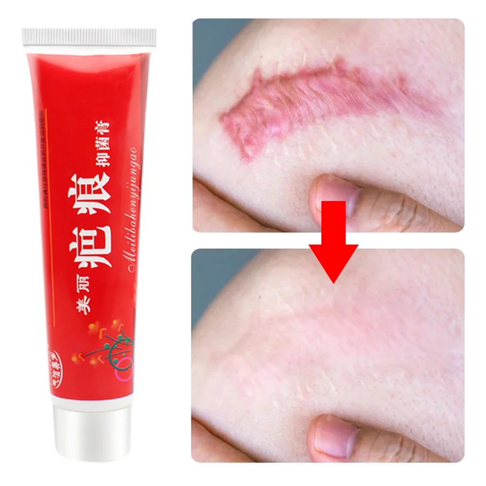 

Acne Scar Removal Cream Pimples Stretch Marks Face Gel Remove Acne Smoothing Whitening Moisturizing Body Skin Care