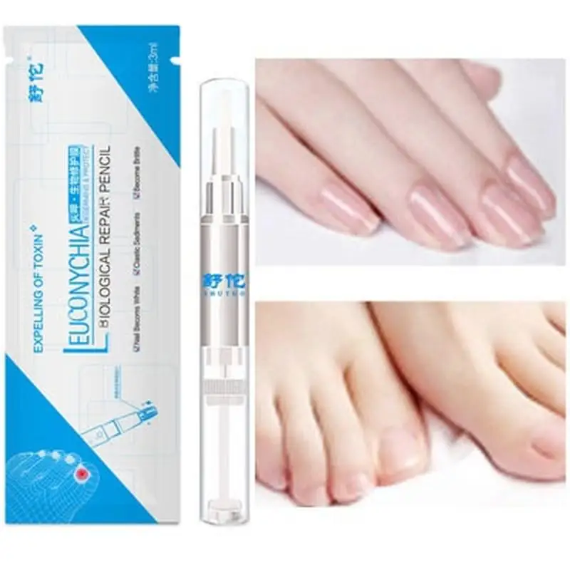 Лечение грибковым грибком ручка для ногтей онихомикоз паронихия травяное