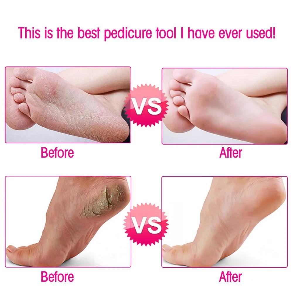 

Electric Pedicure Tools Foot Care Leg Heels Remove Dead Skin Callus Remover Feet Clean Care Machine for Hard Cracked Dry Skin