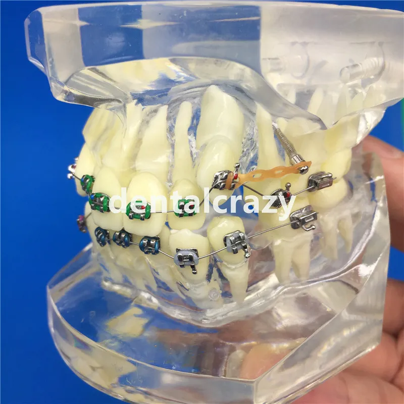 Стоматологическая модель зубов прозрачная ремонта патологического имплантата