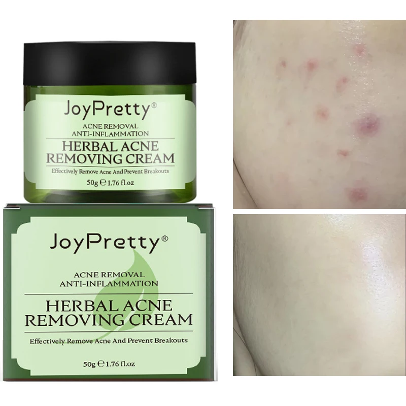 

Acne Herbal Day Cream Skin Care Facial Whitening Moisturizer Oil Control Remove Acne Shrink Pores Natural Ingredients Cosmetic