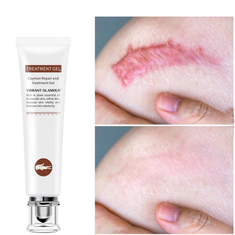 

Средство для удаления растяжек LAIKOU, уход за кожей, крем для шрамов от растяжек, лечение шрамов, Восстанавливающий уход за кожей, крем для тел...