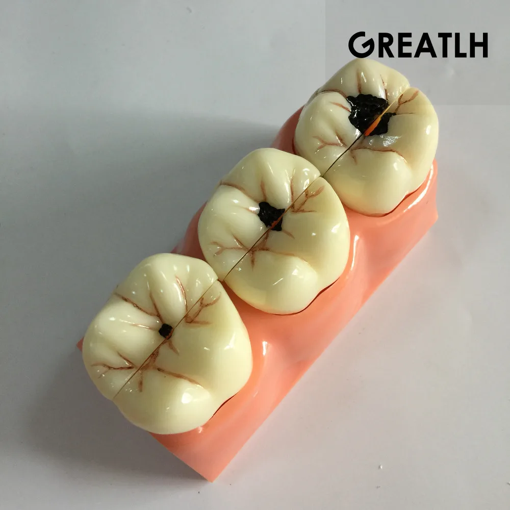 Модель зуба для зубов съемные зубы размер 4:1 обучающая модель|tooth model|removable teethdental