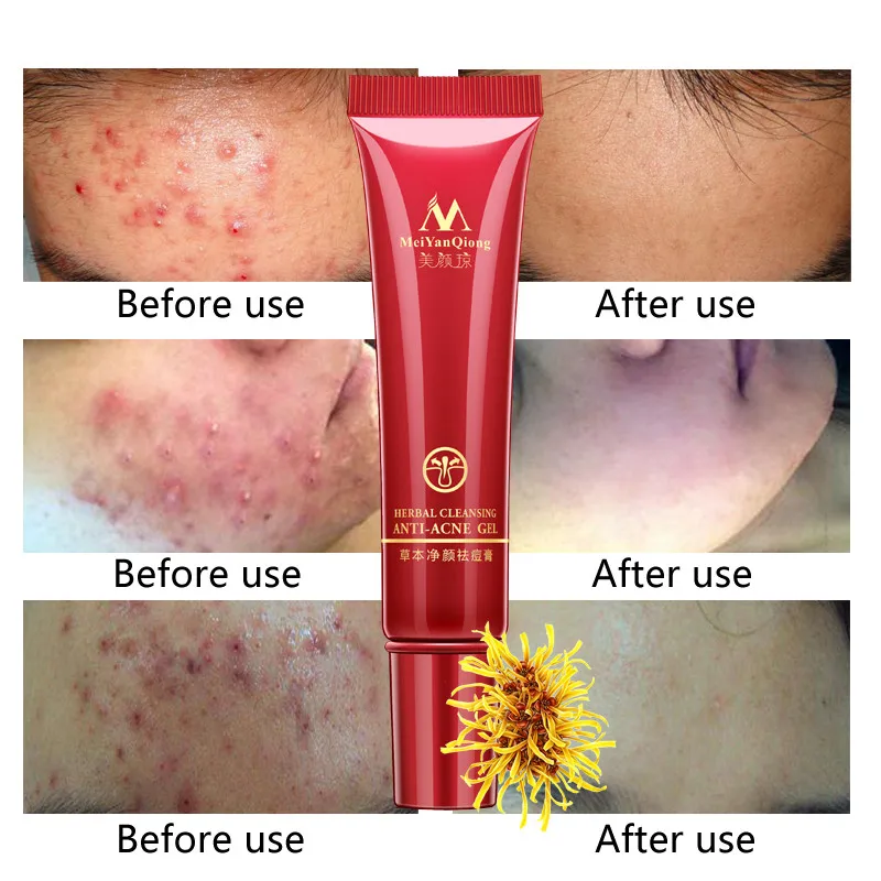 MerYanQiong Acne Treatment Gel Remove Pimples Face Scars Cream Anti Removal Shrink Pores Whitening | Красота и здоровье