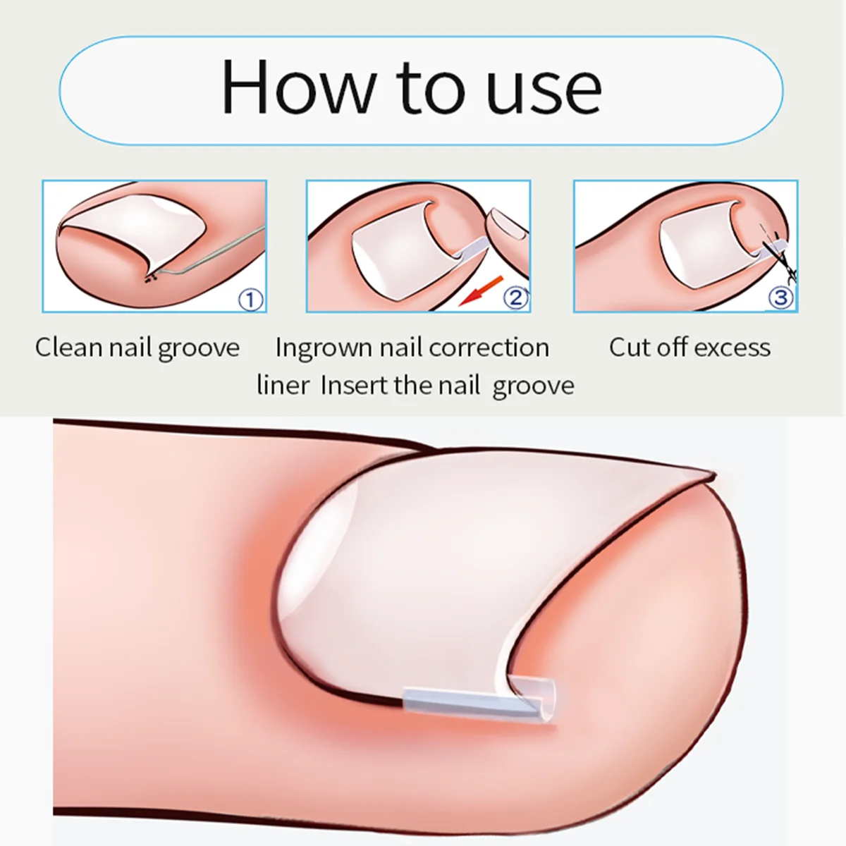 

10Pcs Silicone Ingrown Nail Pad Ortho Nail Filling Nail Groove Pad Ingrown Nail Corrector Relief Pain Paronychia Correction Tool
